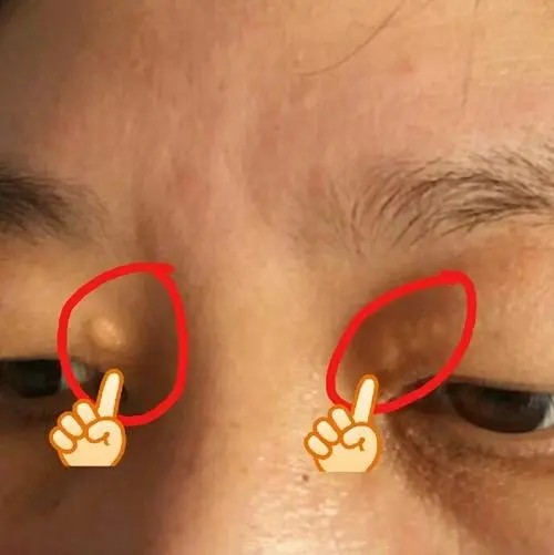 睑黄疣的出现,就是因为血液中脂质成分过高,造成血脂代谢异常,从而