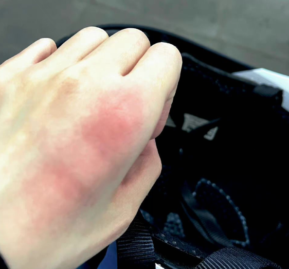 网曝by2孙雨再度住院滑雪时发生意外受伤手一片红肿令人心疼