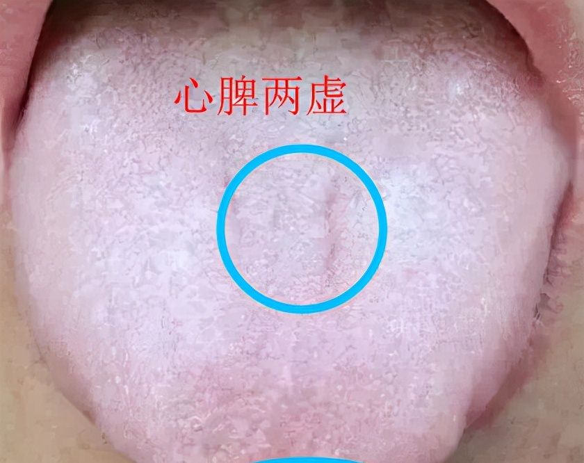 脾虚湿气重,参考舌苔辩证|脾胃|腹胀|健脾_新浪新闻