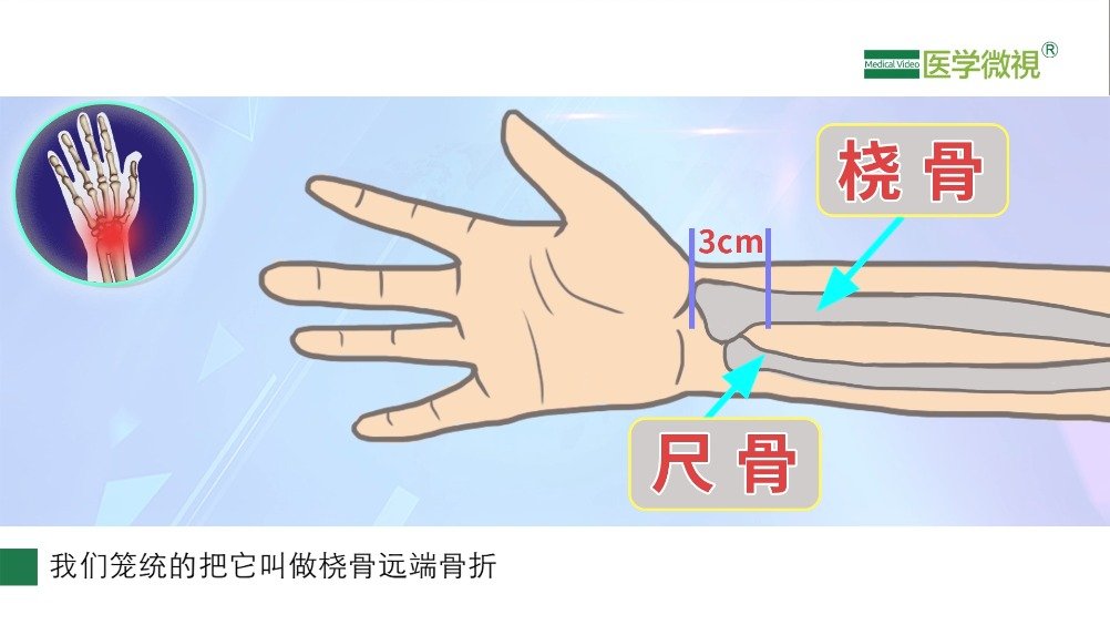 桡骨远端骨折是怎么回事?好发于哪些人群?|骨折|骨科_新浪新闻