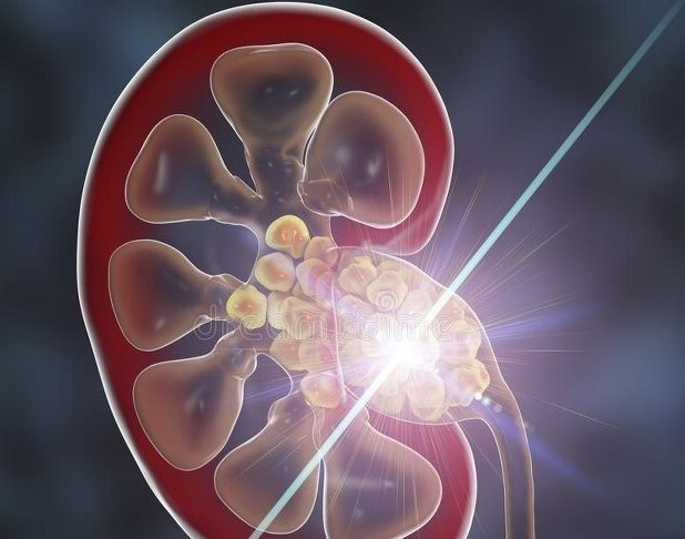 结石频发分享三味中药利湿热消结石摆脱结石困扰