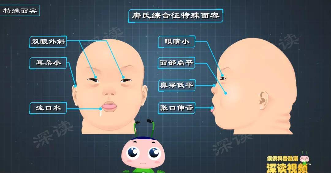 唐氏宝宝有啥症状?备孕姐姐看看