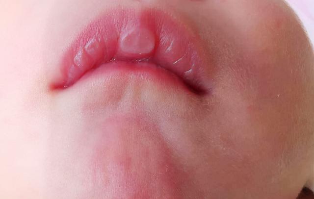 但如果宝宝嘴唇脱皮情况严重,而且一直持续,并且还伴有哭闹不止的情况