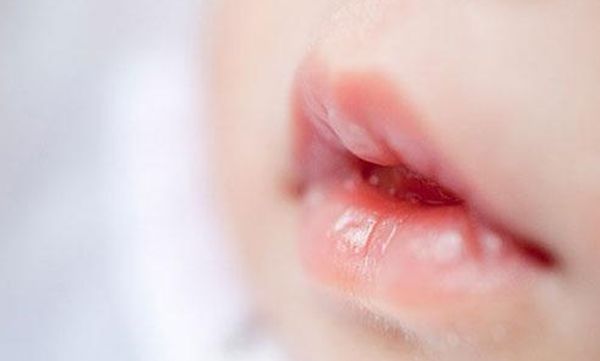 新生宝宝嘴上起泡,还掉皮是什么原因?