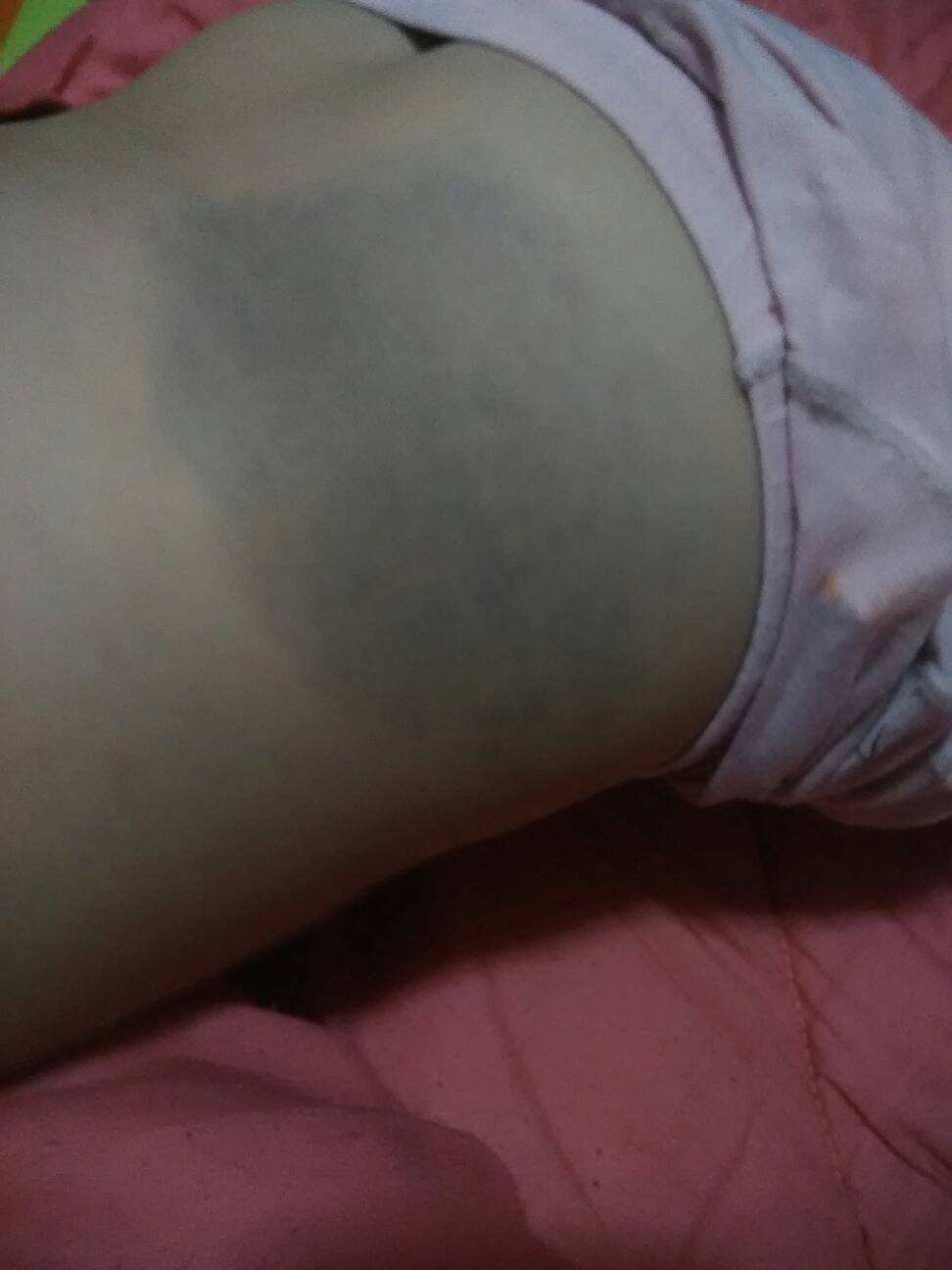 新生儿屁股的“淤青”,是被医生拍的吗?医生的回应把产妇逗笑休闲区蓝鸢梦想 - Www.slyday.coM 新生儿屁股的“淤青”,是被医生拍的吗?医生的回应把产妇逗笑休闲区蓝鸢梦想 - Www.slyday.coM