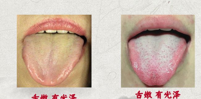 一剂小建中汤增强体质调养身子改善腹痛夜尿症胃溃疡