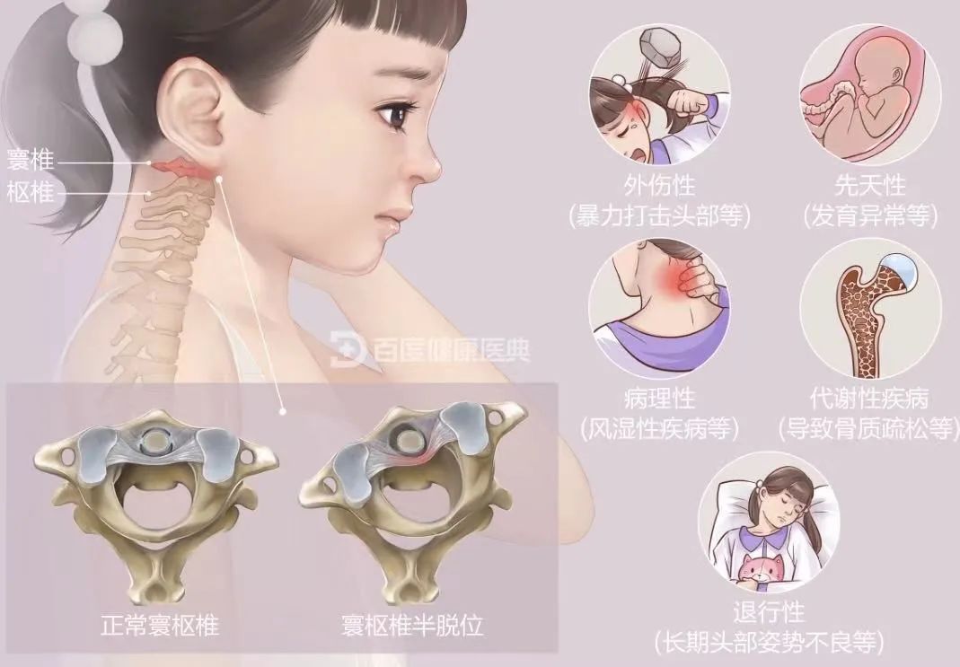 寰枢椎半脱位的病因和治疗方法一起来看脊柱外科专家为您详解怎么就