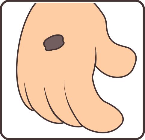 痣也可能会癌变,长在3个地方要注意|黑色素瘤_新浪财经_新浪网