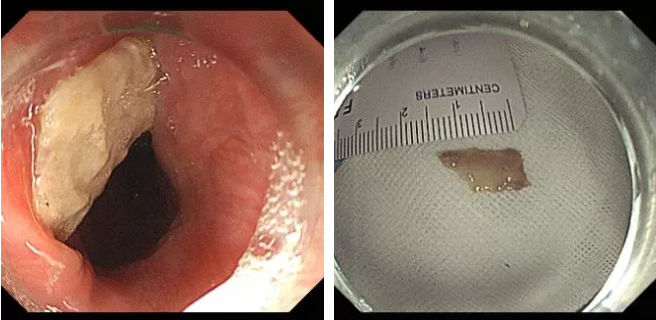 鱼翅卡喉，喝醋吞米饭？“土方法”处理异物不可取休闲区蓝鸢梦想 - Www.slyday.coM