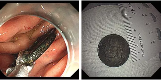 鱼翅卡喉，喝醋吞米饭？“土方法”处理异物不可取休闲区蓝鸢梦想 - Www.slyday.coM