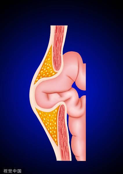 做完腹股沟疝手术腿疼走不了路原路返回找到病因
