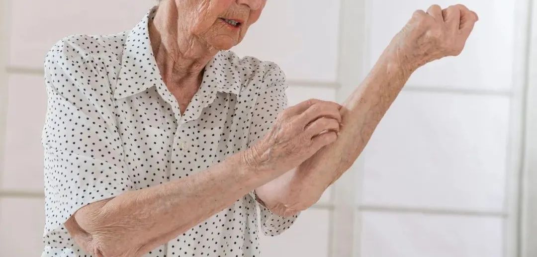 全身发痒这种越挠越痒的皮肤疾患中老年人要注意