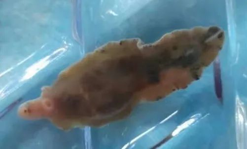 长3.5厘米！广西女子体内取出酷似“鱼”的虫子，是什么寄生虫？休闲区蓝鸢梦想 - Www.slyday.coM