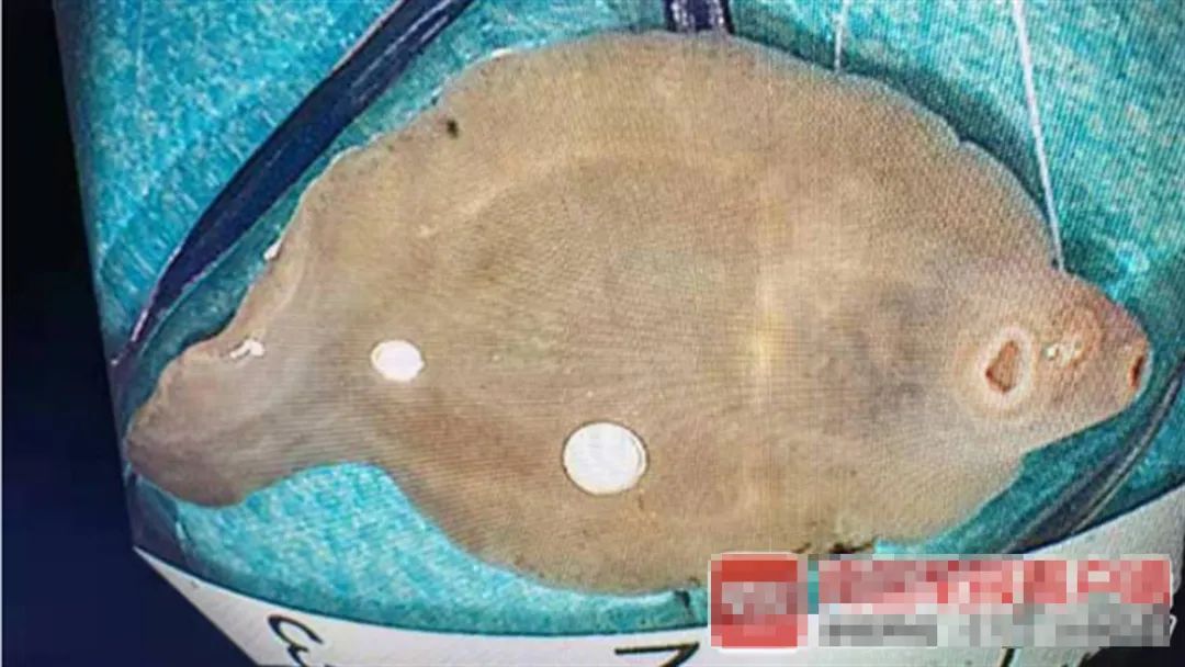 长3.5厘米！广西女子体内取出酷似“鱼”的虫子，是什么寄生虫？休闲区蓝鸢梦想 - Www.slyday.coM