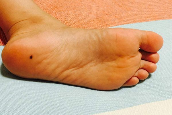 黑痣|脚心|财运_新浪新闻