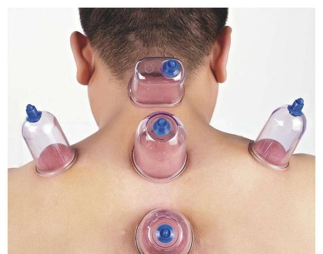 拔罐能排毒吗拔罐后的黑印到底是什么听听医生是怎么说的