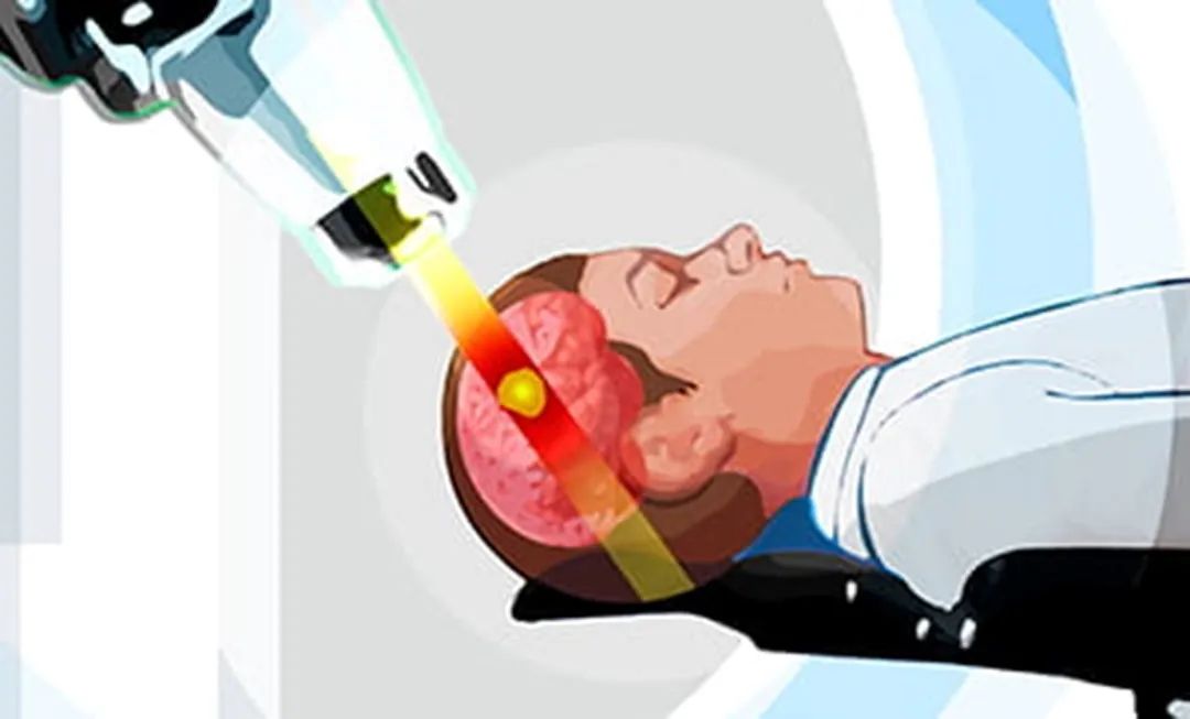 为什么脑部放疗后会觉得自己"变笨了"?| 脑科学科普专栏34期