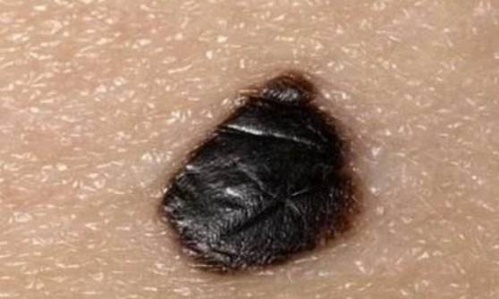 医生直言若皮肤上长出这东西多半是肝硬化登门拜访