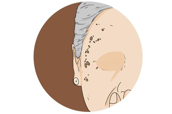 老年斑是人体衰老的自然现象不必重视四种方法教你改善