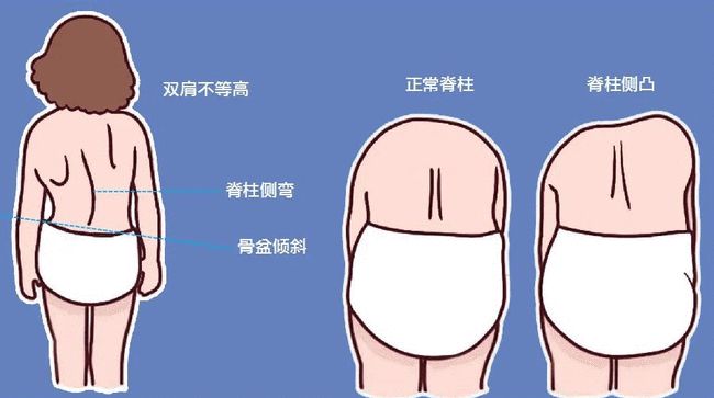 小儿推拿杨晓儿童脊柱侧弯你了解多少如何治疗预防脊柱侧弯