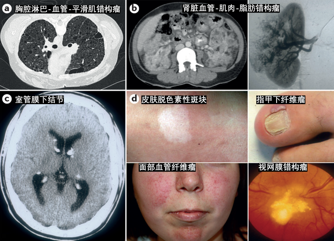 谁是元凶结节性硬化病变溯源脑科学科普专栏35期