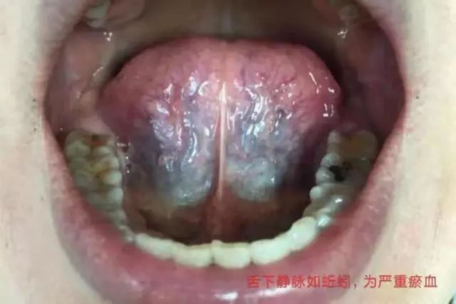 舌下血管四级瘀堵图片