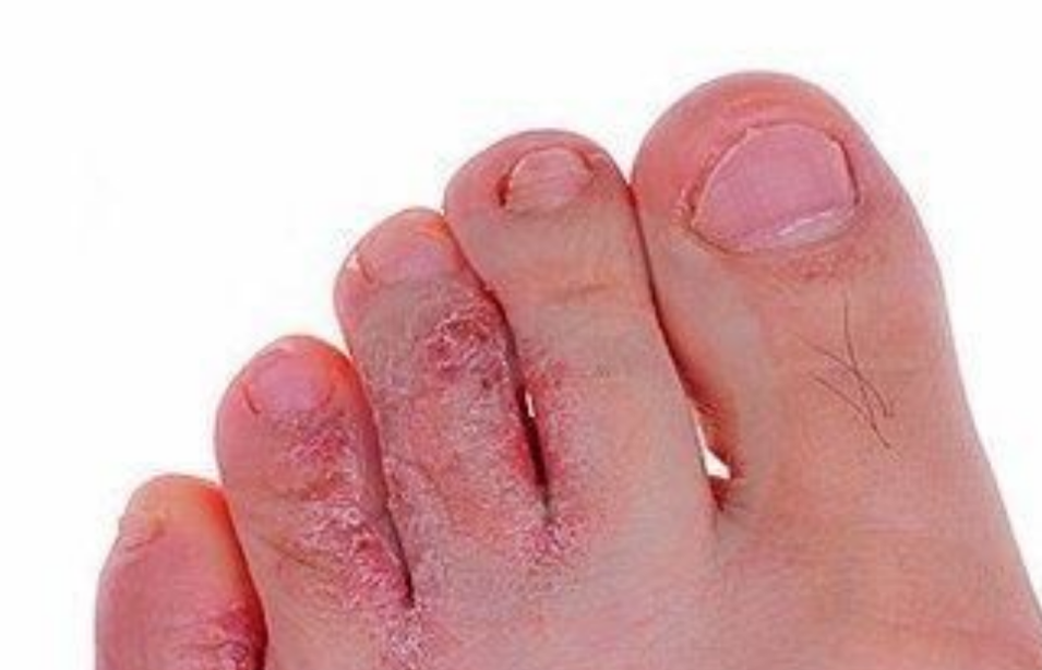 反复发作的手足癣三大类型和用药方案整理