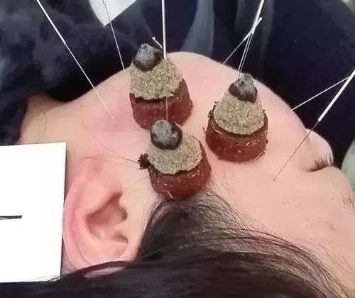 四管齐下治面瘫