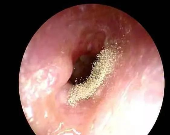 【聚焦】那些爱掏耳屎的人，后来都怎么样了？休闲区蓝鸢梦想 - Www.slyday.coM