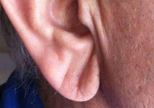 耳垂出现这条折痕也许是大病预警不花钱的养心法早知道早受益