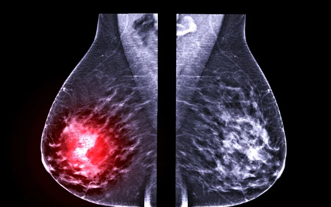 乳腺结节不会自己消失3种情况要当心恶变