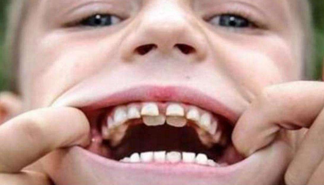 宝宝换牙期间如何避免孩子出现双排牙牙齿长歪的情况呢