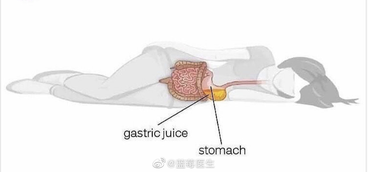 上次说有为食道返流的同学应该左侧卧位