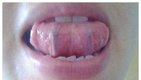 舌头下的青筋变得粗大,还鼓起来了如果只是舌下青筋发黑,没有什么其他