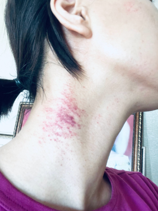 被虫子咬了会起鸡皮疙瘩(被哪种虫子咬了会长小疙瘩) 被虫子咬了会起鸡皮疙瘩(被哪种虫子咬了会长小疙瘩)