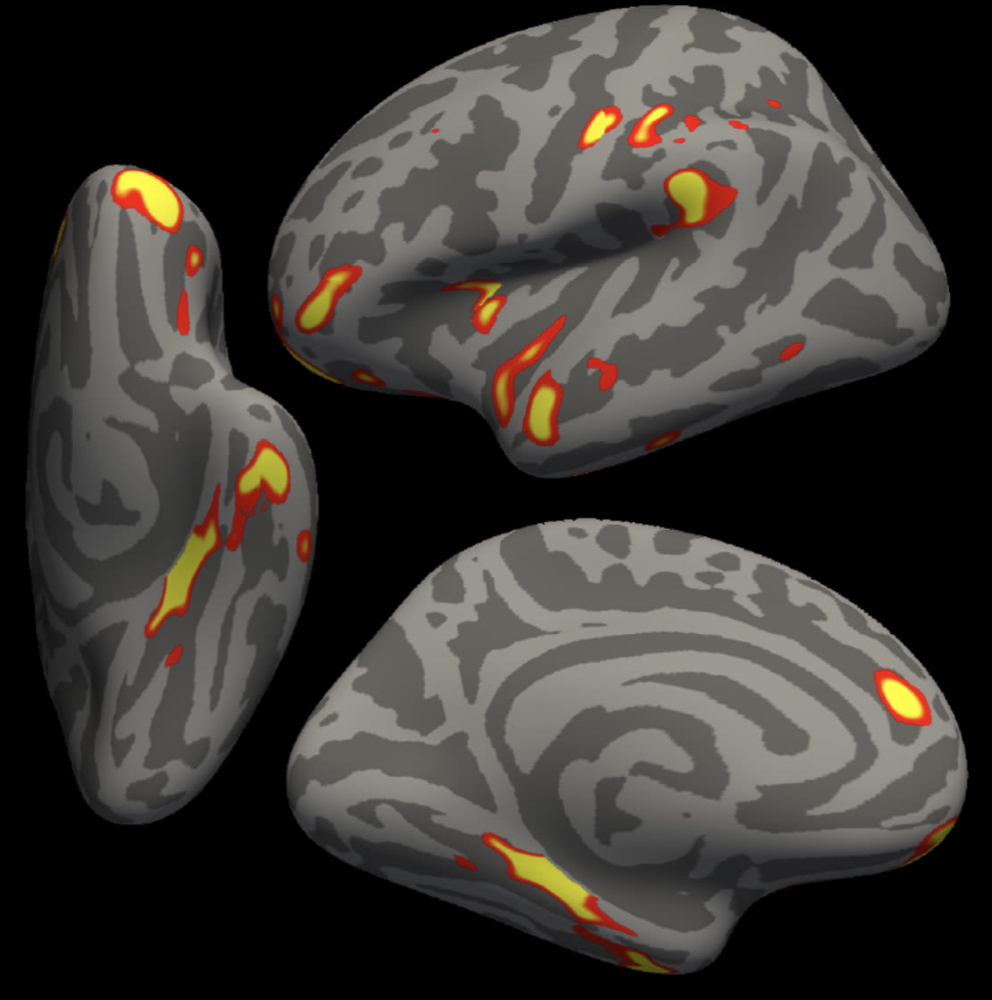 脑部影像对比显示新冠中老年患者大脑加速萎缩