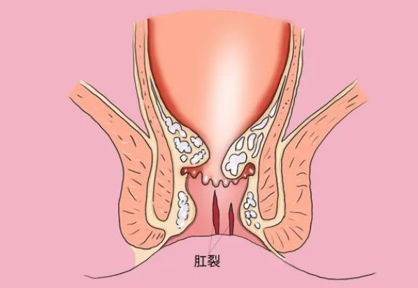 北京东大肛医院是正规医院?肛裂多久能愈合