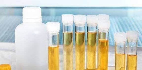 男人尿液出现泡沫就一定是尿蛋白吗别害怕还有可能是这种情况