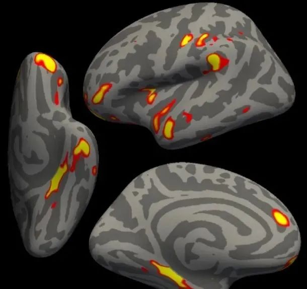 警惕！最新研究表明，新冠后遗症会造成大脑萎缩，轻症也不例外！休闲区蓝鸢梦想 - Www.slyday.coM