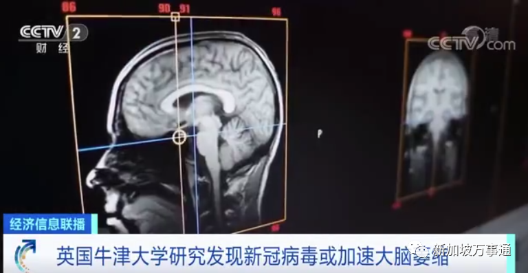 新冠后遗症新发现：病毒或加速大脑萎缩、或使人提前衰老1休闲区蓝鸢梦想 - Www.slyday.coM