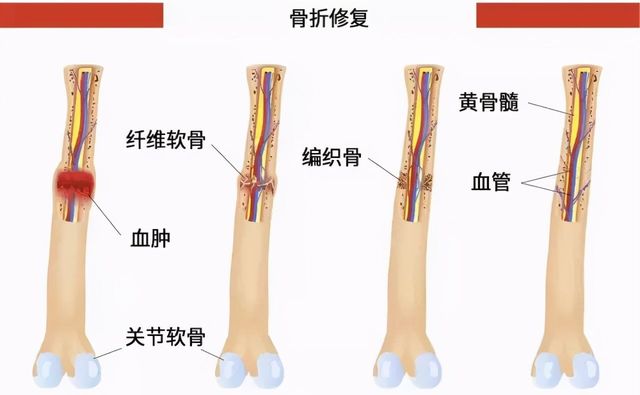 同样是骨,为何有些能劈砖裂石?|骨骼|骨折|骨痂_新浪新闻