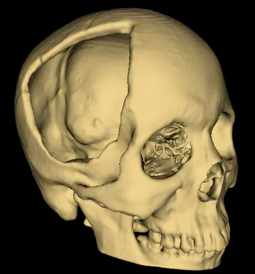 手术情况:术后患者情况,颅骨及头皮三维重建:陕西省核工业二一五医院