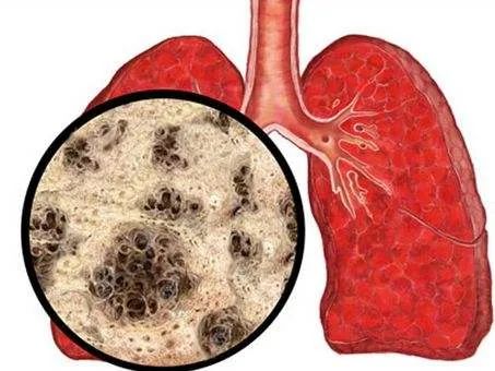 肺大泡,医学上又叫肺大疱,是指由于各种原因导致肺泡腔内压力升高