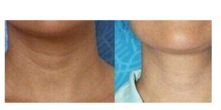 身体好不好看脖子就知道?若脖子上有这种标志,可能癌细胞想活跃休闲区蓝鸢梦想 - Www.slyday.coM 身体好不好看脖子就知道?若脖子上有这种标志,可能癌细胞想活跃休闲区蓝鸢梦想 - Www.slyday.coM