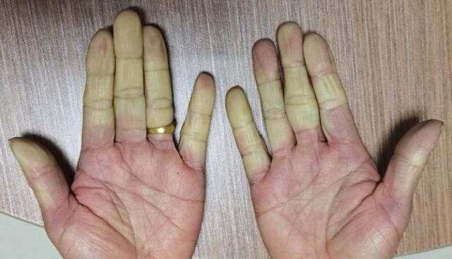 为什么手指突然发白医生可能是雷诺现象小心类风湿性关节炎