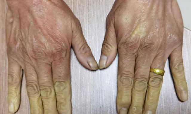 为什么手指突然发白医生可能是雷诺现象小心类风湿性关节炎