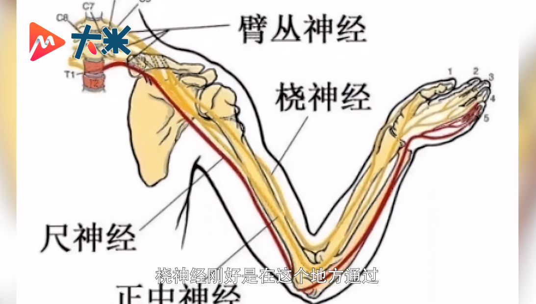 1个小时后醒来发现右手失去知觉,被诊断"右上肢桡神经损伤",经治疗已
