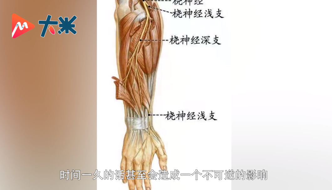 手臂午睡,1个小时后醒来发现右手失去知觉,被诊断"右上肢桡神经损伤"
