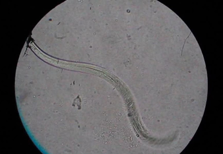 10岁男孩长期头痛竟与蜗牛有关