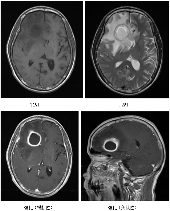 大意| 头疼拖了半月差点要命,竟然要开颅才逃过一劫|脑脓肿|神经外科
